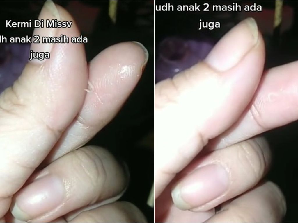 Viral Cacing Kremi Keluar dari Miss V Ibu 2 Anak, Kok Bisa?