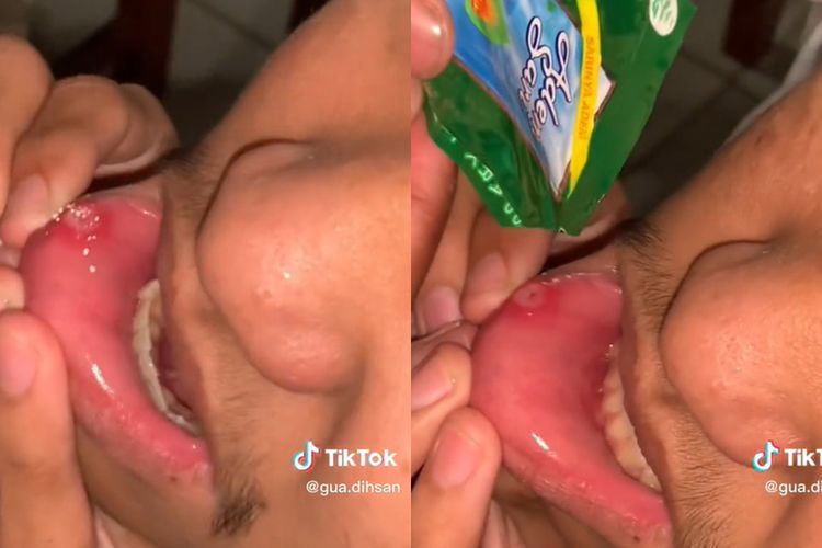 Remaja Ini Taburi Obat Sariawan Langsung di Bibir, Ekspresinya Menahan Perih Bikin Ngakak