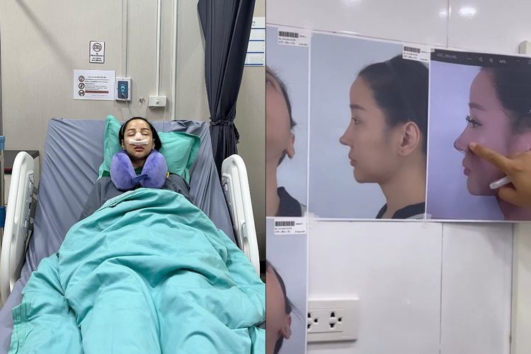 Lucinta Luna Operasi Plastik Lagi karena Dihujat Mirip Pinokio, Begini Penampakan Hasilnya