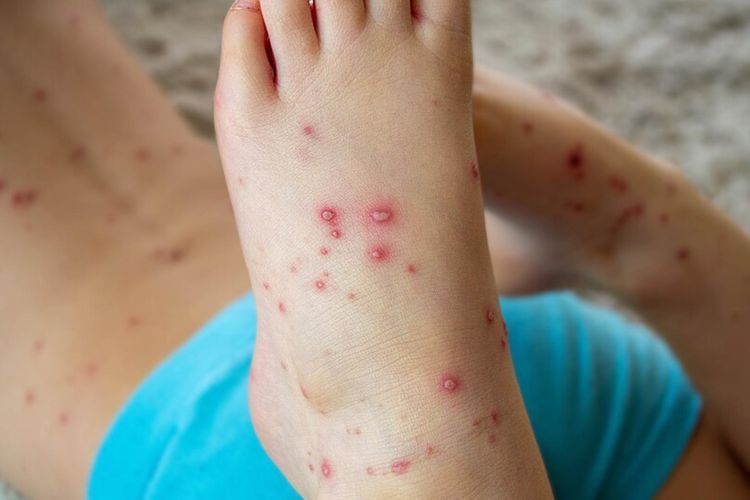 Dokter Sarankan Penderita Campak Lakukan Isolasi agar Tidak Menularkan Virus