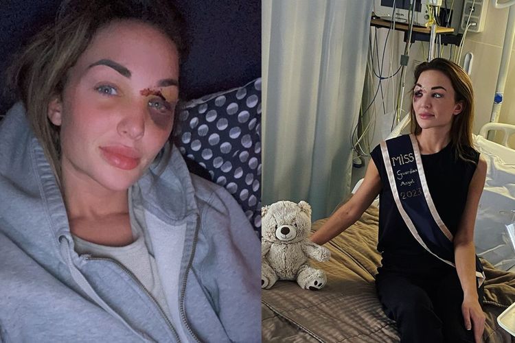 Miss Belgia 2022 Kecelakaan, Bekas Luka di Area Mata Nodai Wajah si Ratu Kecantikan
