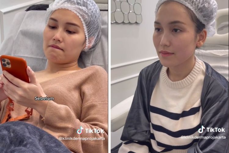 Ayu Ting Ting Tanam Benang Biar Hidung Mancung, Netizen: Kata Ayah Ojak Cantik Alami