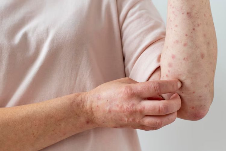 Puluhan Ribu Orang Terpapar Virus Campak Menular Usai Hadiri Acara Keagamaan