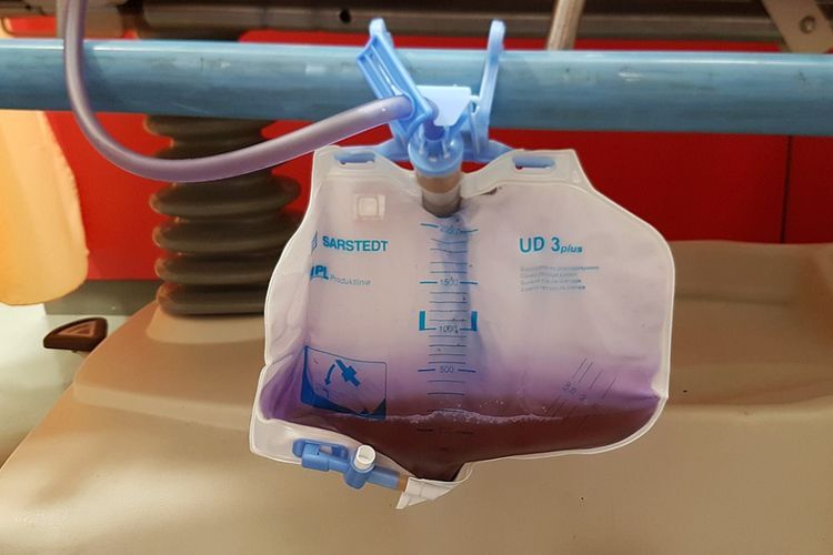 Urine Nenek Ini Berubah Jadi Ungu Gara-gara Idap Infeksi Saluran Kemih