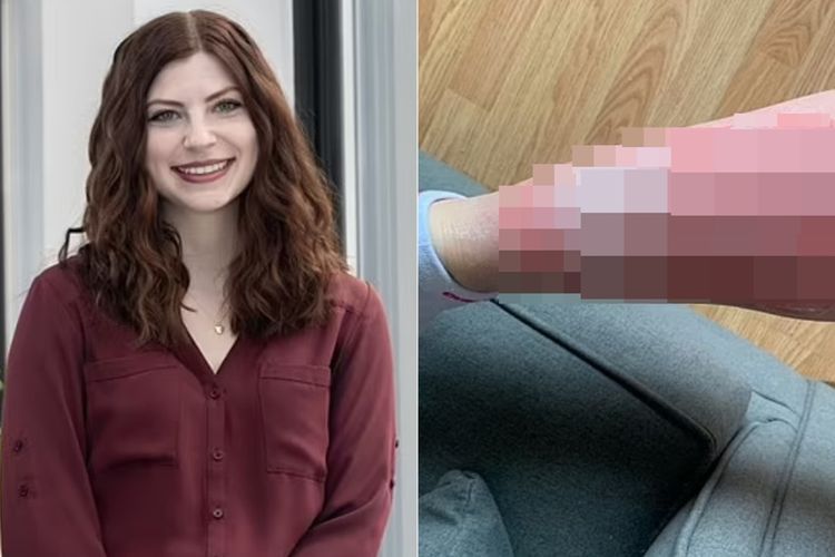 Ngeri! Kulit Cewek Cantik Ini Gampang Mengelupas dan Pecah-pecah karena Kondisi Langka