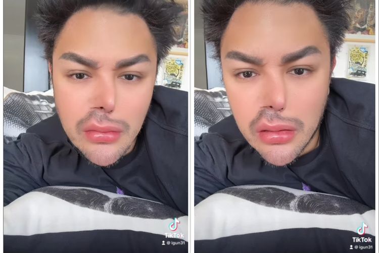 Ivan Gunawan Pamer Bentuk Hidung yang Tiba-tiba Penyok, Buat Heboh dan Panik