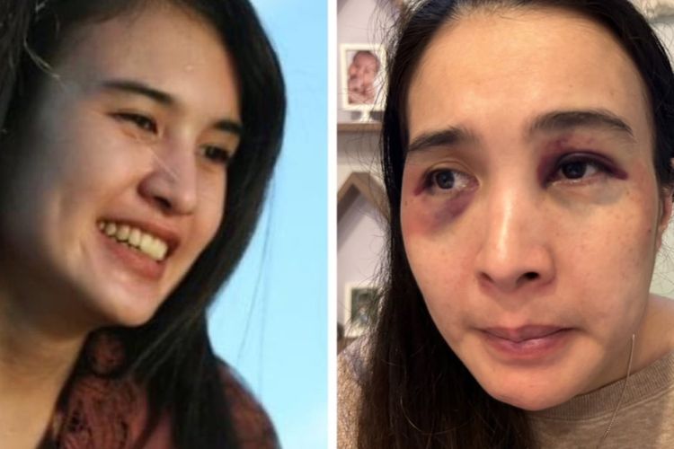 Hampir Mati Ulah KDRT Suami, Ibu 3 Anak Malah Ditahan dan Jadi Tersangka usai Lapor Polisi