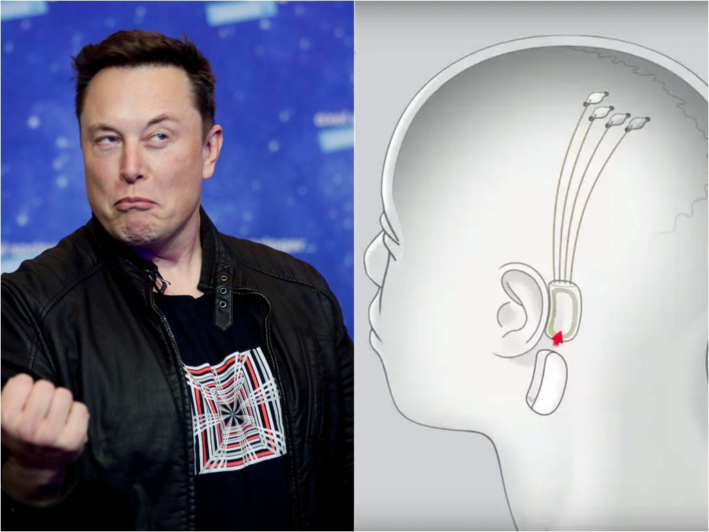 Elon Musk Berhasil Tanam Chip ke Otak Manusia! Penggunanya Bisa Telepati!