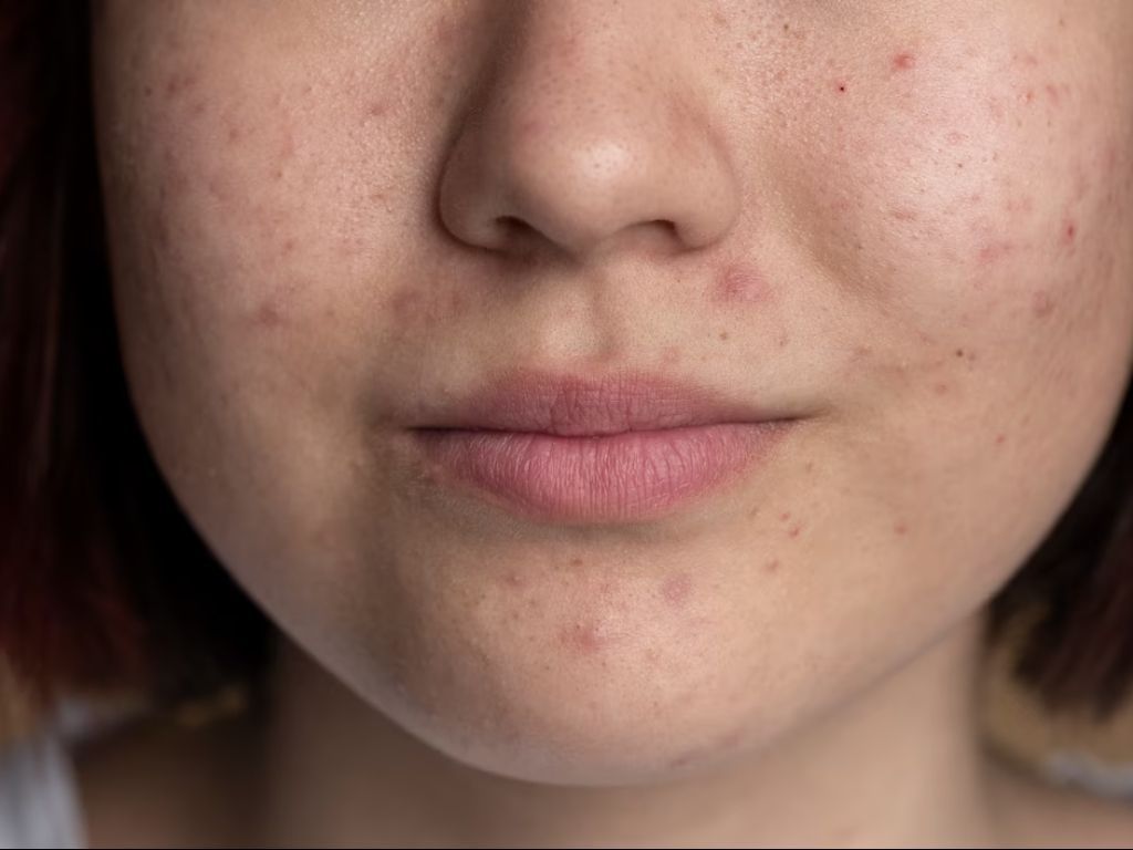 4 Tips Memakai Retinol Tanpa Purging, Lakuin Ini! 