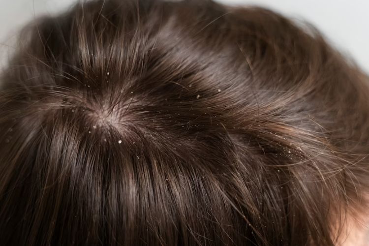 7 Cara Menghilangkan Ketombe Kering Paling Efektif, Coba Yuk!