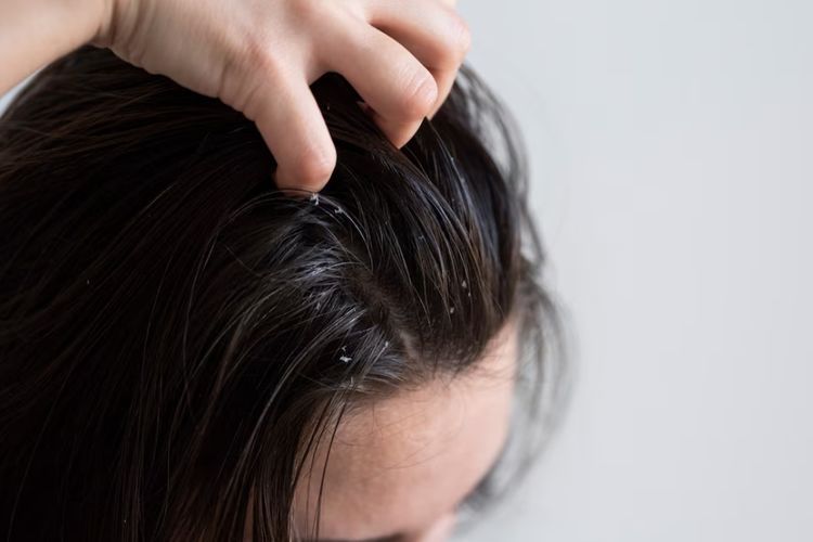 5 Cara Menghilangkan Ketombe Basah di Kulit Kepala, Coba Ini! 