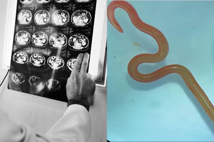 Pertama di Dunia! Dokter Temukan Cacing Hidup di Dalam Otak Wanita Australia
