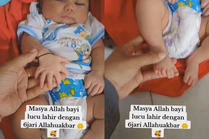 Viral, Bayi Perempuan di Sampang Madura Lahir dengan 24 Jari di Tangan dan Kakinya