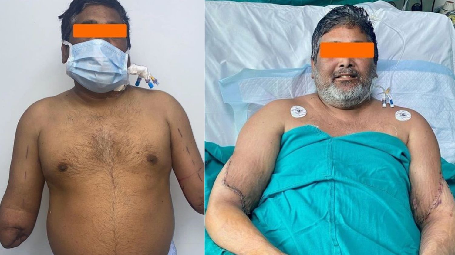 Viral! Pelukis India Sukses Jalani Transplantasi Donor Tangan Bilateral Pertama di New Delhi