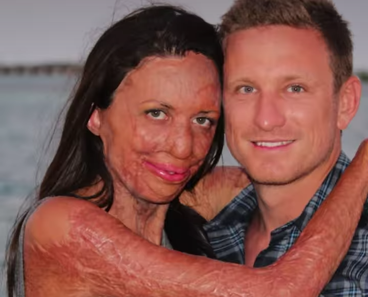 Kisah Inspiratif Turia Pitt: Buktikan Cinta Sejati Mampu Sembuhkan Luka Fisik
