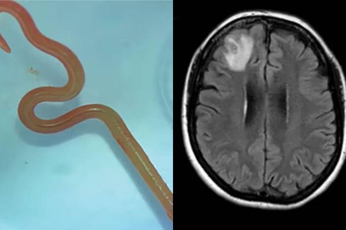 Cerita Dokter Australia Temukan Cacing di Otak Pasien yang Alami Gejala Pikun, Kasus Medis Pertama di Dunia