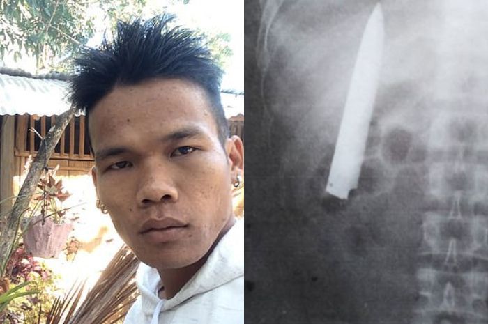 Pria Filipina Ini Gak Tahu Ada Pisau Tertancap di Tubuhnya, Ketahuan saat Medical Check Up Masuk Kerja