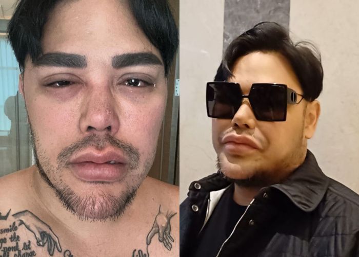 Foto Mata Bengkak hingga Sesak Napas Bikin Geger, Ternyata Ini yang Dialami Ivan Gunawan