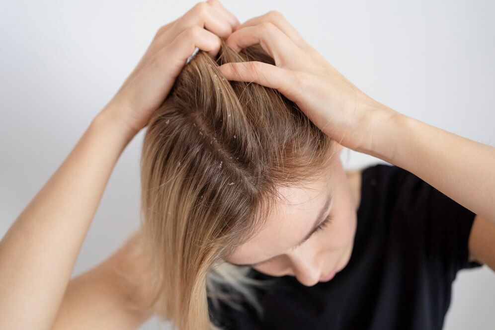 Solusi Ampuh Hilangkan Kutu pada Rambut secara Efektif