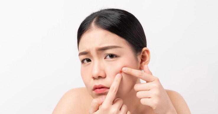 Tips Jitu Agar Jerawat Tidak On-Off di Wajah yang Kamu Harus Tau!