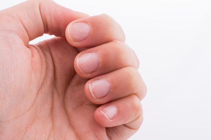 8 Tips Mudah Mengatasi Kuku Kering dan Rapuh, Apa Saja?