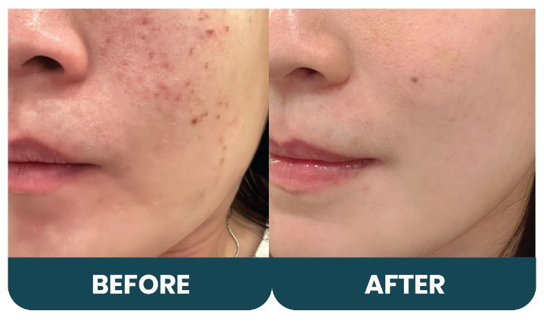 3 Tips Ampuh Hilangkan Flek Hitam di Wajah: Skincare, Peeling hingga Laser