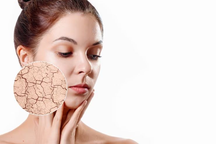 3 Cara Memilih Pelembab yang Cocok untuk Kulit Kering