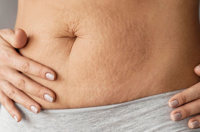 Apa Itu Stretch Mark? Simak Penyebab, Cara Mengatasi dan Tips Mencegahnya