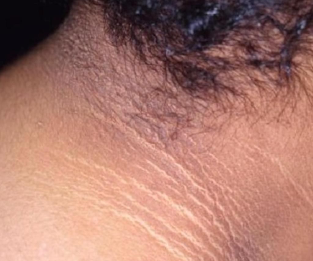 Bukan karena Jarang Mandi, Ternyata Ini Penyebab Leher hingga Selangkangan Hitam