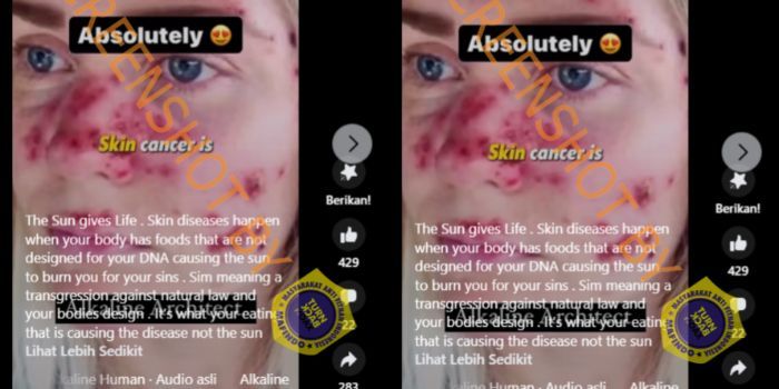 Viral, Sunscreen Bisa Sebabkan Kanker Kulit, Ini Faktanya!