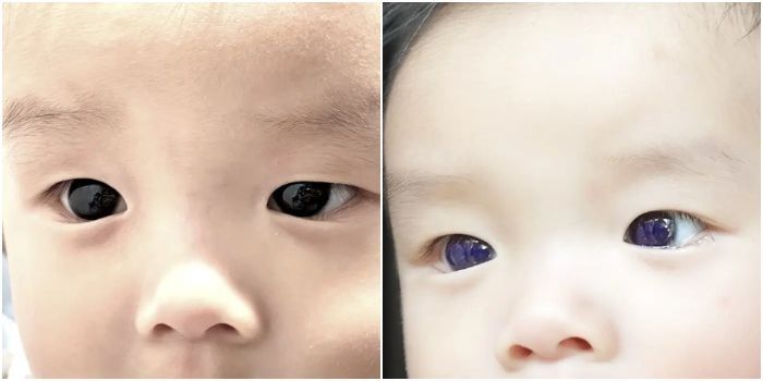 Mata Bayi Ini Berubah dari Coklat Tua ke Biru Cerah Usai Konsumsi Obat COVID-19, Kok Bisa?