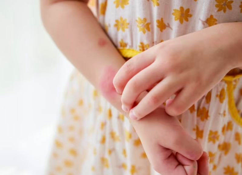 Bukan Cuma Polusi Udara, Rupanya Ini Penyebab Anak-anak Zaman Sekarang Alergi dan Asma