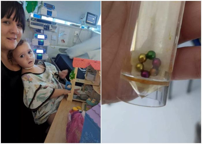 Ngeri! Usus Balita Ini Berlubang Gara-gara Telan 6 Bola Fidget Magnetic, Sampai Muntah Cairan Hijau