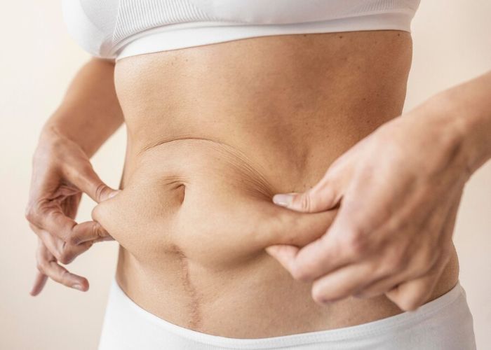 Niat Hilangin Kulit Bergelambir, Perut Wanita Ini Malah Membusuk dan Bau karena Sedot Lemak Gagal