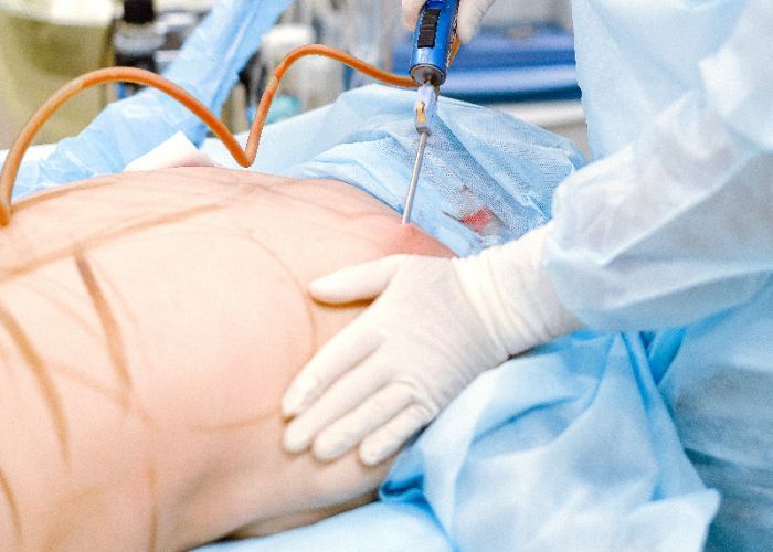 Kenali Manfaat dan Bahaya Sedot Lemak, Prosedur Operasi yang Diduga Jadi Penyebab Meninggalnya Nanie Darham