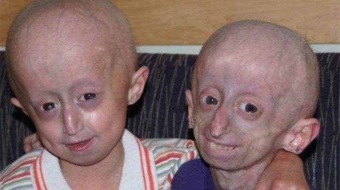 Progeria, Penyakit Langka yang Menyebabkan Penuaan Dini pada Anak Kecil