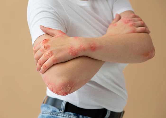 Mengenal Aquagenic Urticaria, Alergi Langka saat Kulit Terpapar Air