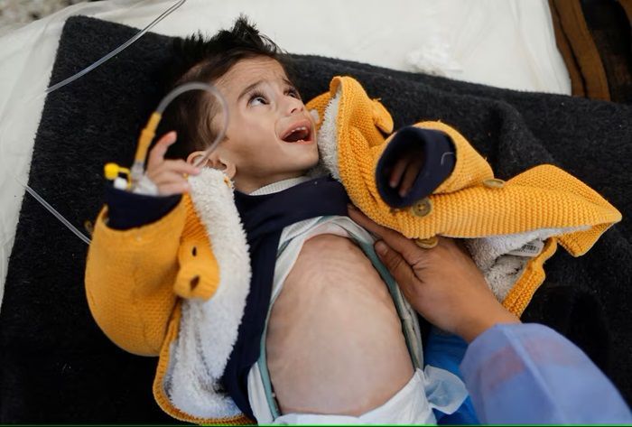 Gaza Dilanda Bencana Kelaparan, Ini Efek Jangka Panjang Penderita Gizi Buruk