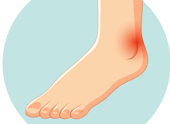 5 Tips Mengatasi Keseleo dengan Cepat dan Efektif
