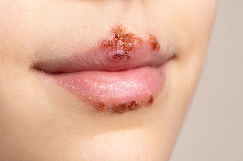 Apa Itu Herpes dan Penyebabnya: Mengungkap Penyakit Viral yang Umum