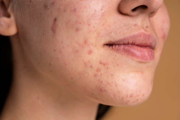 5 Cara Menghilangkan Jerawat di Wajah dengan Cepat, Cuma Pakai Bahan Alami