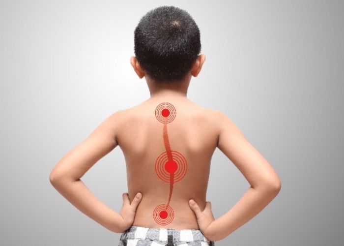 Penyebab Skoliosis pada Anak Ternyata Berasal dari Otak? Ini 5 Faktanya