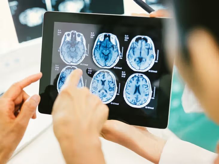5 Mitos dan Fakta Tumor Otak, Nomor 4 Paling Umum!