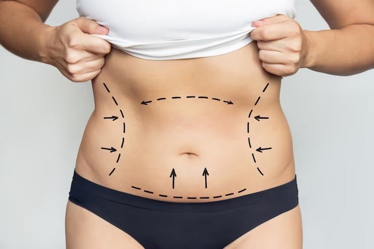 9 Hal Penting yang Harus Diketahui Sebelum Sedot Lemak, Ternyata Tidak Menurunkan Berat Badan?