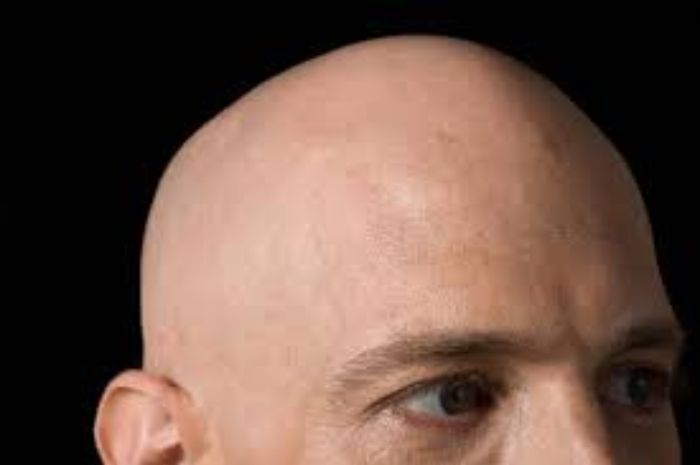 7 Cara untuk Mencegah Kebotakan Rambut karena Genetik