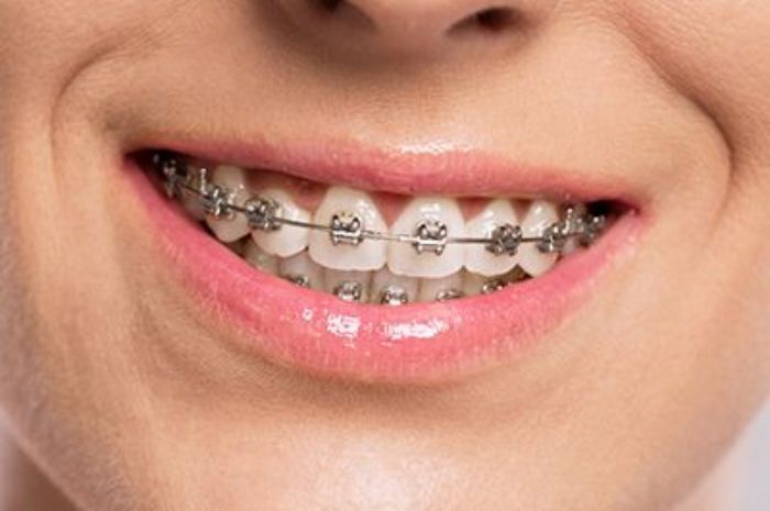 7 Tips Merawat Behel Agar Gigi Tetap Sehat dan Hasil Maksimal
