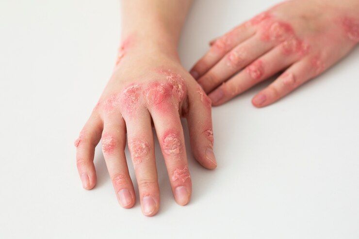 Makanan Sehat untuk Psoriasis dan Cara Mencegah Kekambuhan