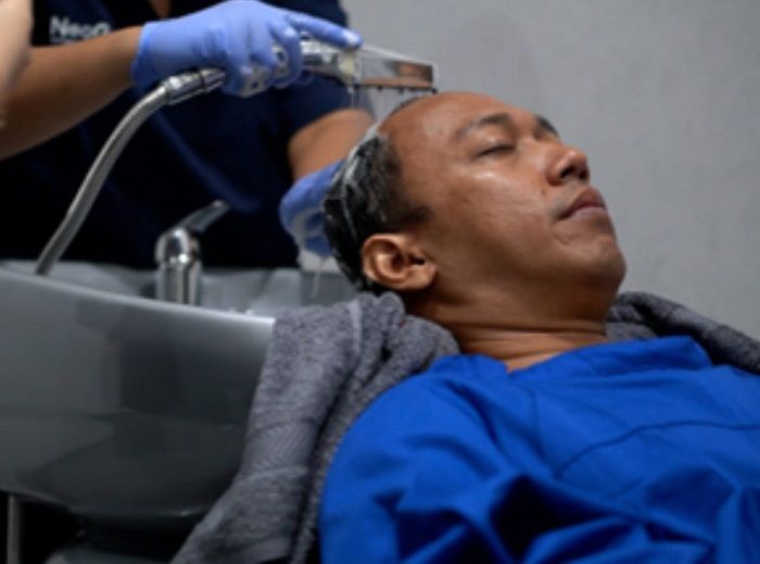 10 Hal yang Perlu Dilakukan Sebelum Transplantasi Rambut Pertama Kali
