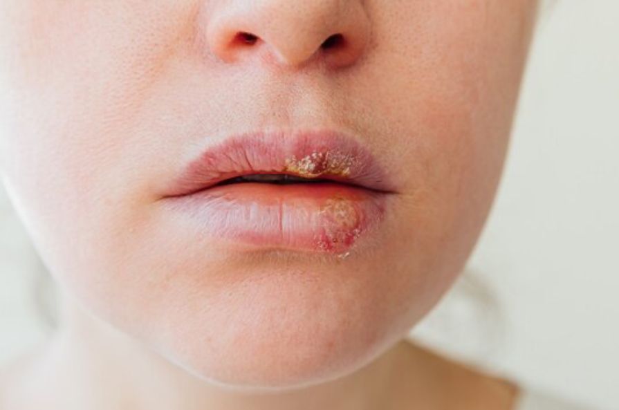 Atasi Bibir Pecah-pecah dan Kering Nggak Lagi Ribet! Ini Tips Simpel yang Ampuh Banget