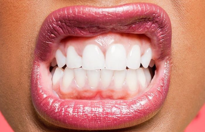 Mengenal Bruxism, Kebiasaan Menggertakkan Gigi saat Tidur yang Bisa Jadi Tanda Stres